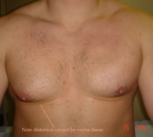 Pre operative picture of gynaecomastia on right side causing unwanted swelling of right pectoral and nipple area. This was removed by Mr Turton through a small cosmetic incision hidden in areola.