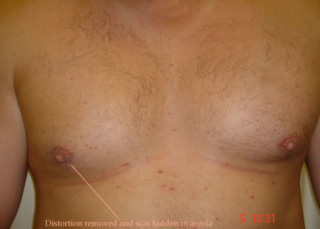 Post-operative result just 2-weeks later. No visible scar.