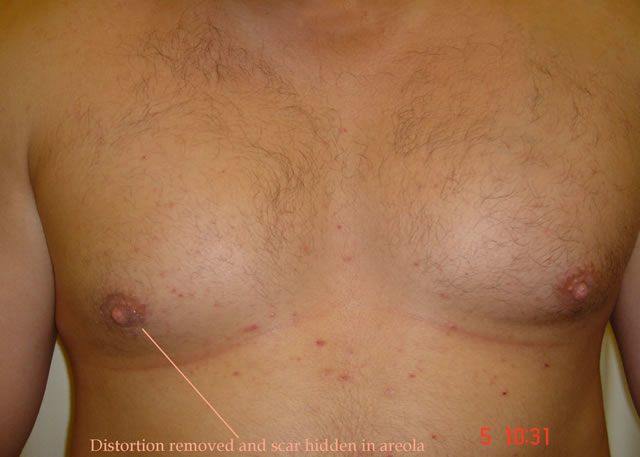 Post-operative result just 2-weeks later. No visible scar.