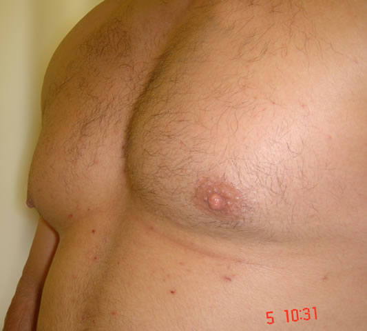 Post-operative result just 2-weeks later. No visible scar.