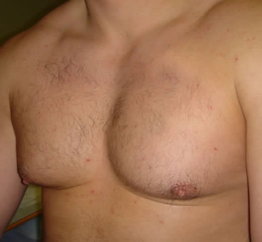 Pre operative picture of gynaecomastia on right side causing unwanted swelling of right pectoral and nipple area. This was removed by Mr Turton through a small cosmetic incision hidden in areola.