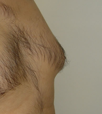 In the profile view the embarrasing cosmetic disfigurement of male gynaecomastia is most obvious. The nipple is pushed forwards by the underlying tissue.