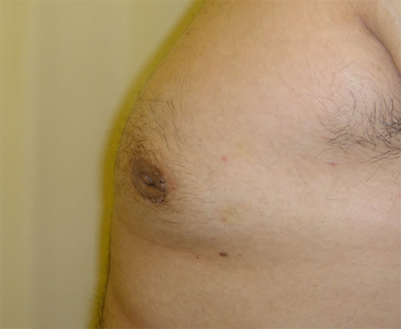 At 3-weeks after male breast reduction surgery by Mr Turton, through a very fine peri-areola incision,