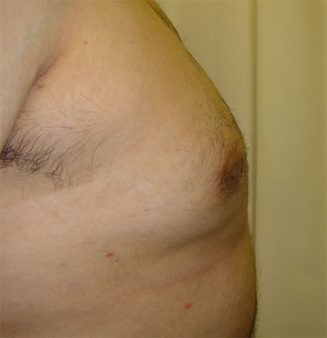 There is some post-operative swelling still present which takes a further 3-weeks to resolve