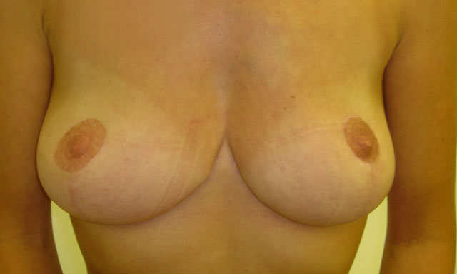 Bilateral Mastopexy (Wise pattern) Reduction weight right: 125gm, left: 245gm 4-months after surgery