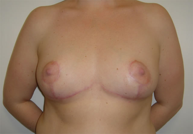 5-months post breast reduction by Mr Turton of right: 1045 gms and left: 975 grms.