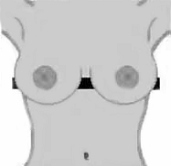 grade 1 nipple level