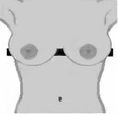 grade 2 nipple less than 3cm