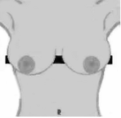 grade 3 nipple greater