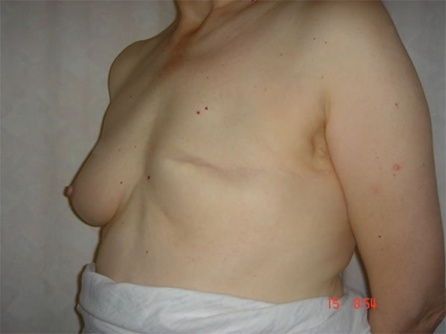 This patient had a previous mastectomy and requested reconstruction.