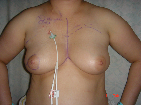 An immediate mastectomy has been performed after initial chemotherapy