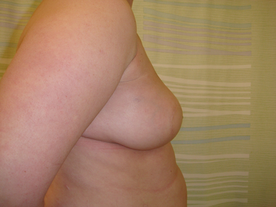 2-years following a fully tissue based reconstruction