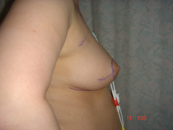 areola was used on the breast to perform the mastectomy and to place the tissue flap.