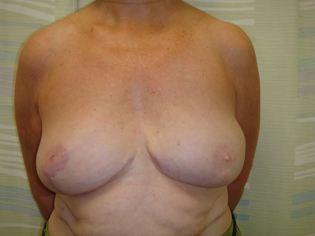 1-year following a fully tissue based left breast reconstruction