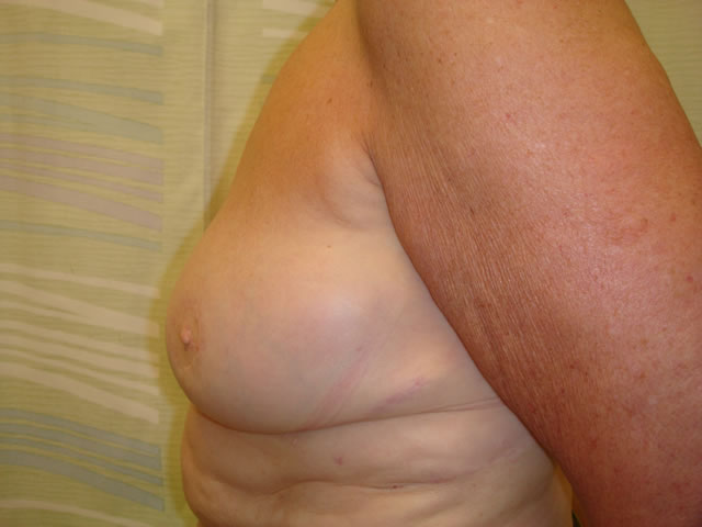 ipsilateral nipple reconstruction performed by Mr Turton.