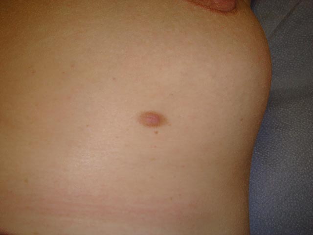 Accessory Nipples - Do they matter?