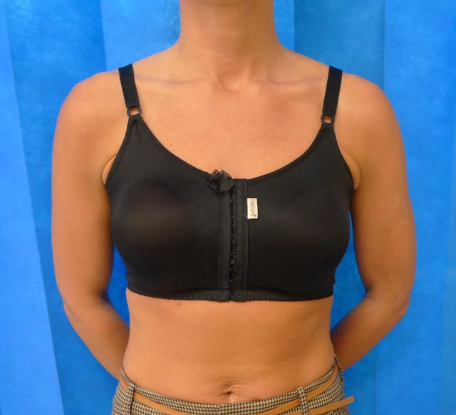 Philip Turton - Best Post Breast Surgery Bra - Breast Enlargement