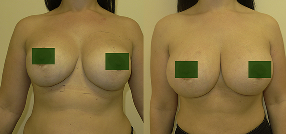 Breast Enlargement Surgery – Improving the results