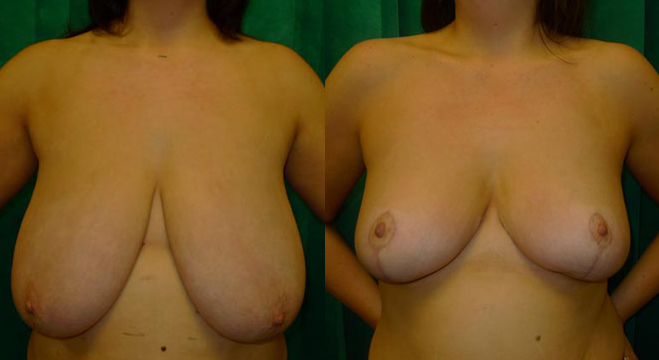 Breast Reduction Philip Turton Cosmetic Breast Surgeon