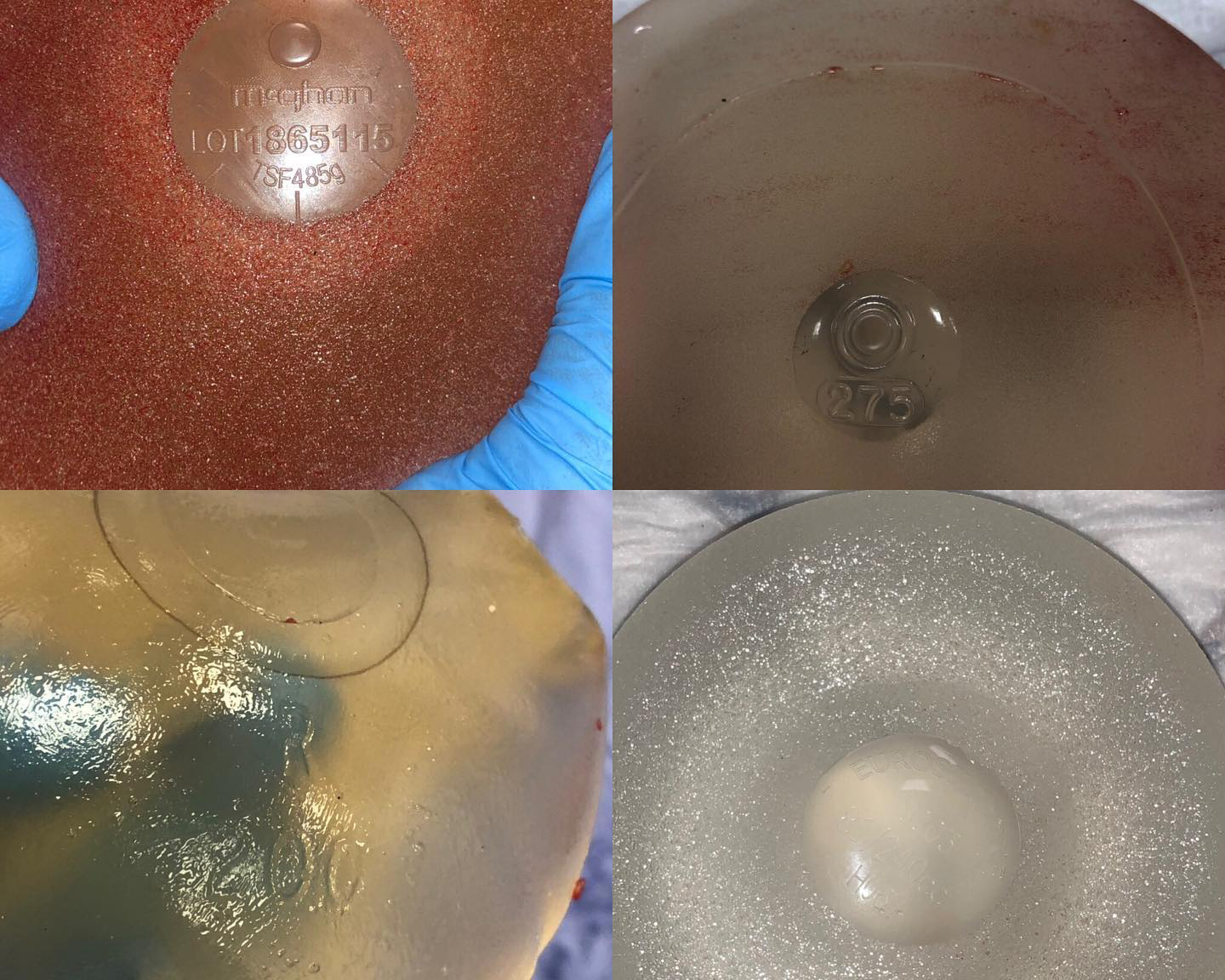 How Do I Identify Old Silicone Breast Implants?