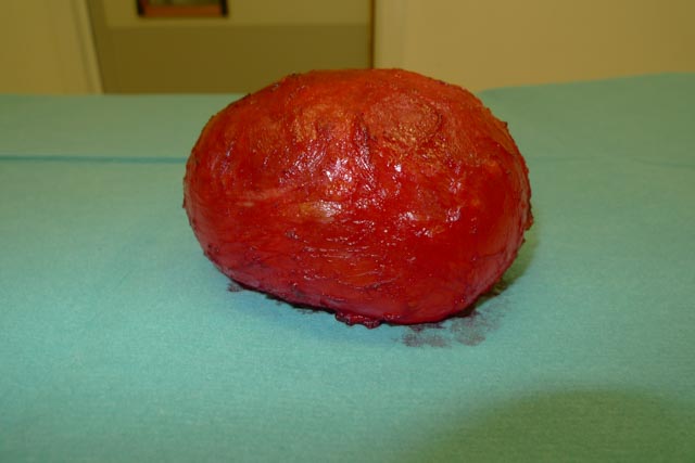 Removal of Silicone Breast Implants
