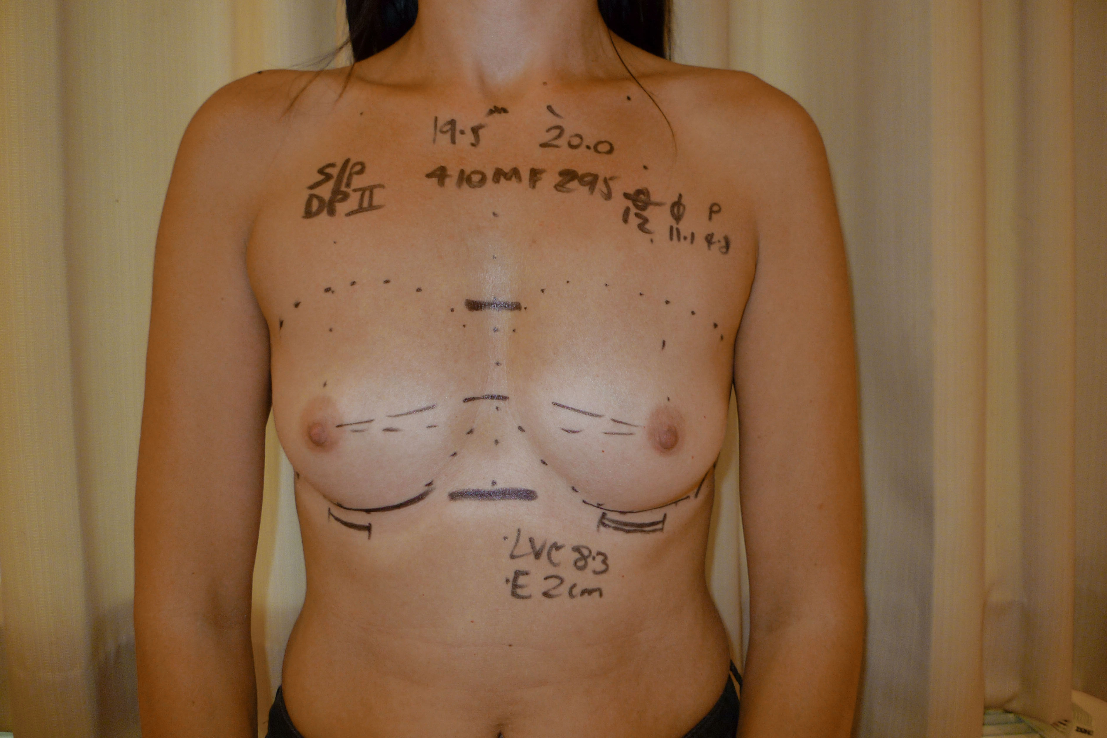 What Size Breast Implants Should I Get For My Boob Job?