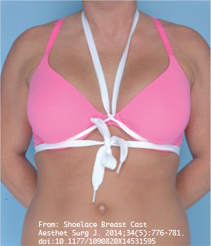 Double Bubble Deformity after Breast Augmentation