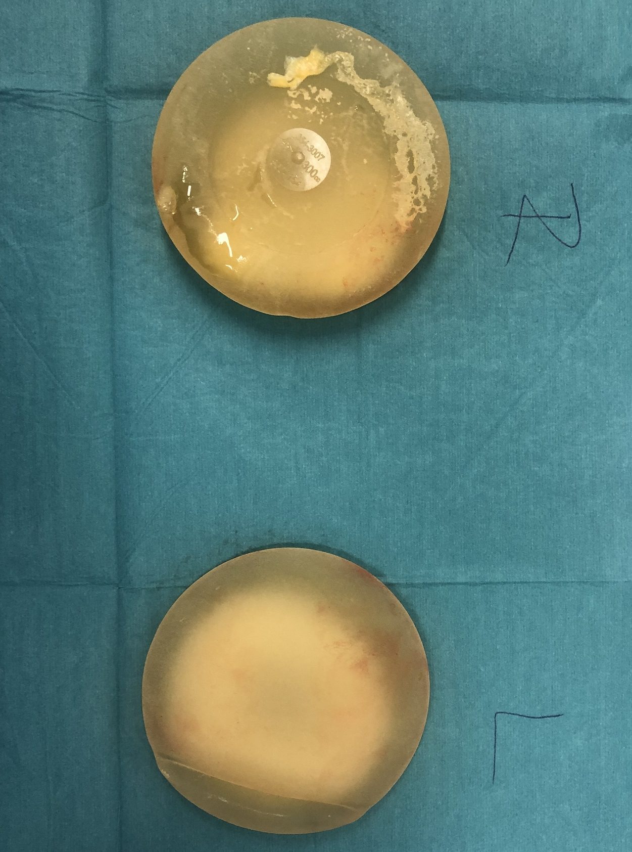 How long do Breast Implants last and What is Silent Implant Rupture?