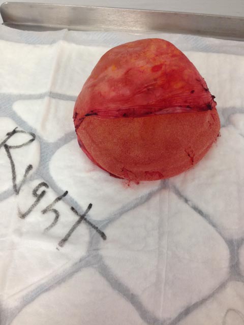 Breast Implant Removal UK-cosmetic-breast
