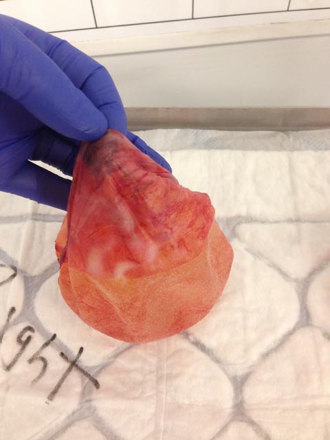 Breast Implant Removal UK
