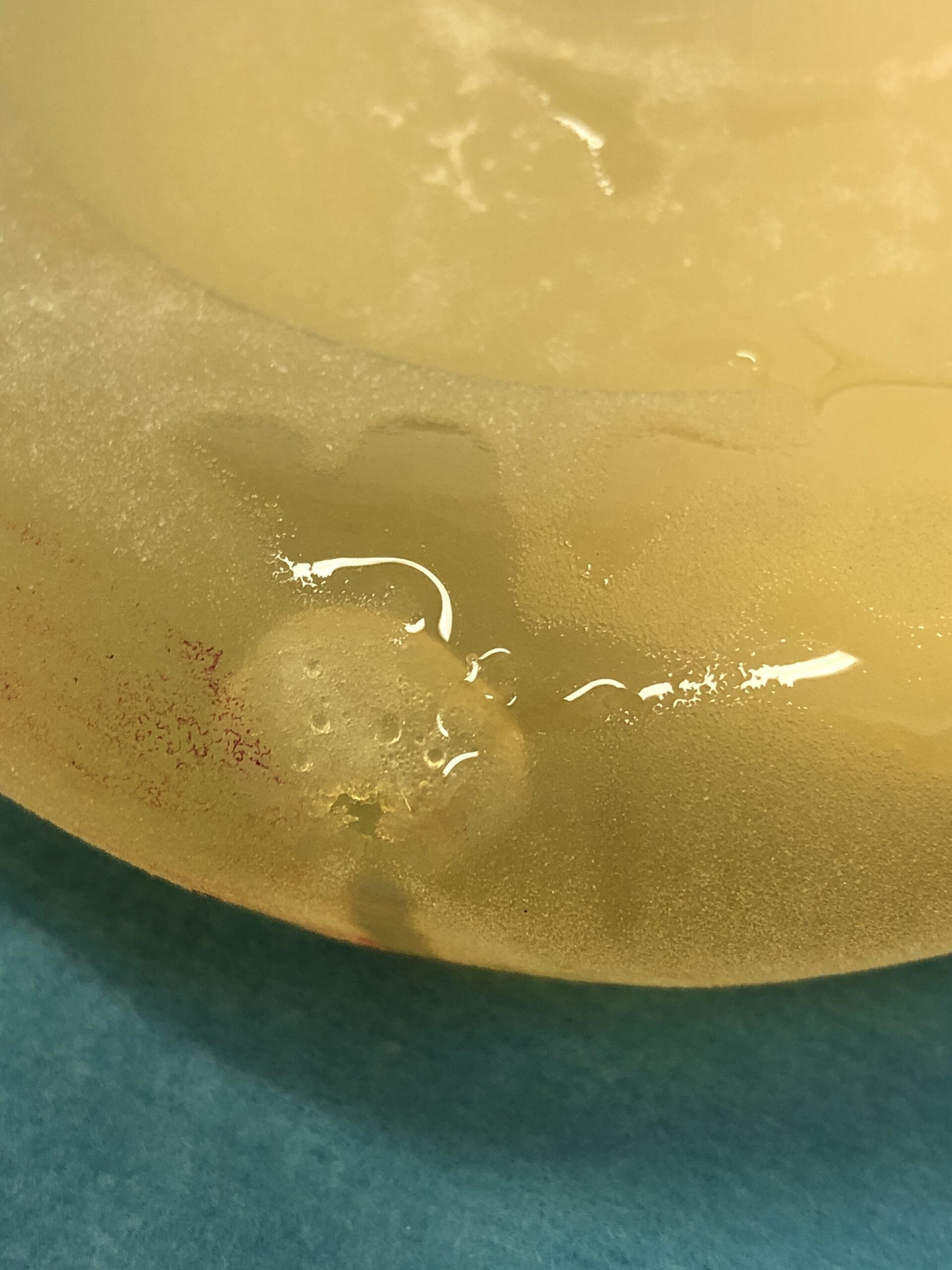 ruptured breast implant