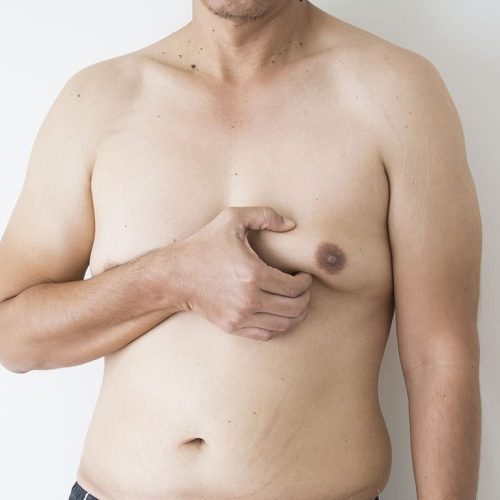 gynaecomastia01