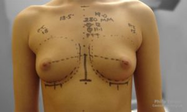 Breast augmentation before and after images