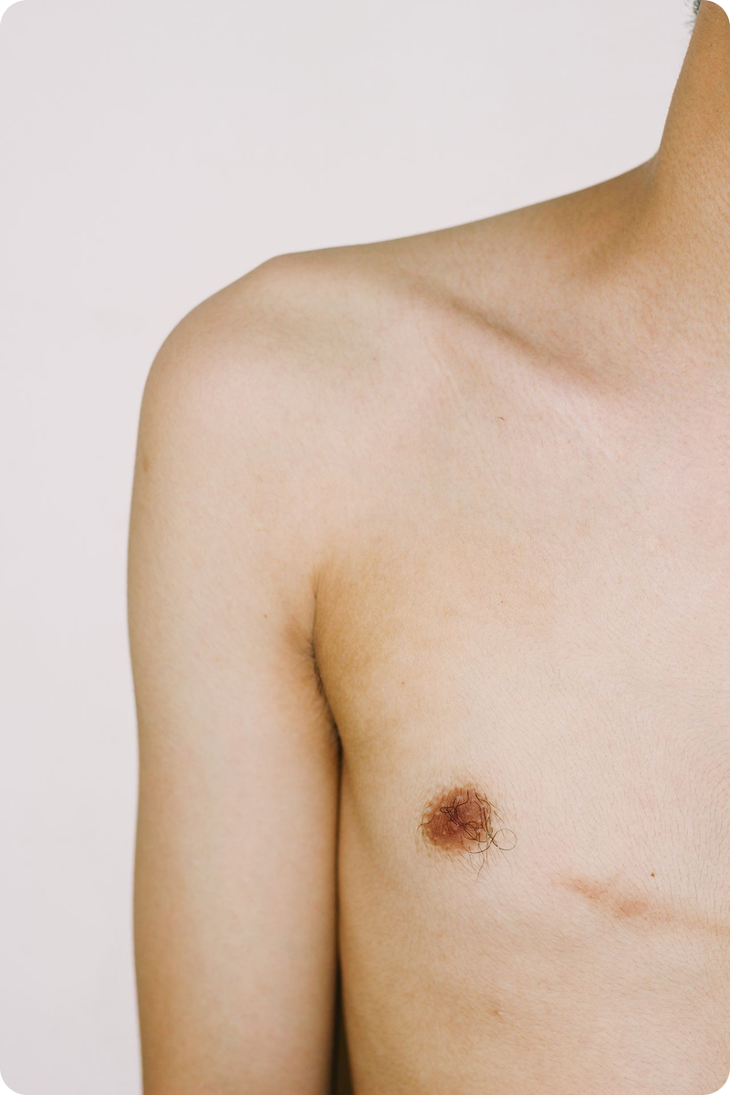 Male breast liposuction procedure