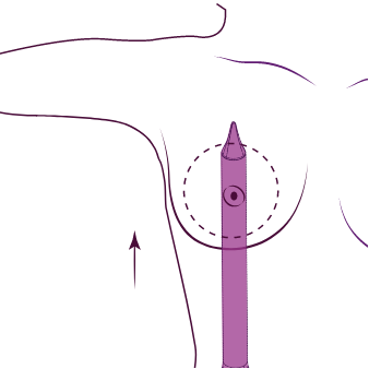Illustration of breast implant placement and surgical instruments used in a breast augmentation procedure