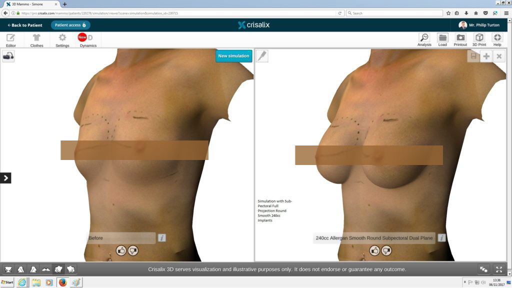 Crisalix 3D simulation- The Best Implants for Your Breast Enlargement