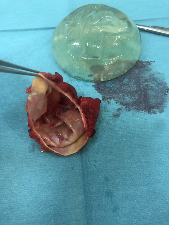 Removal of Silicone Breast Implants