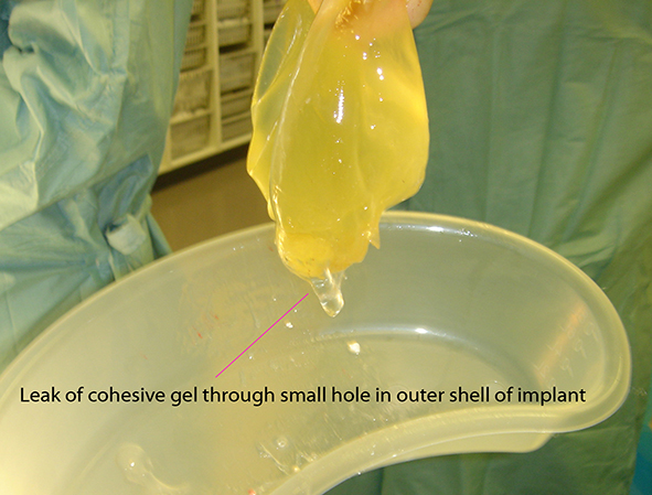 How Do You Know If Your Breast Implant Is Ruptured?