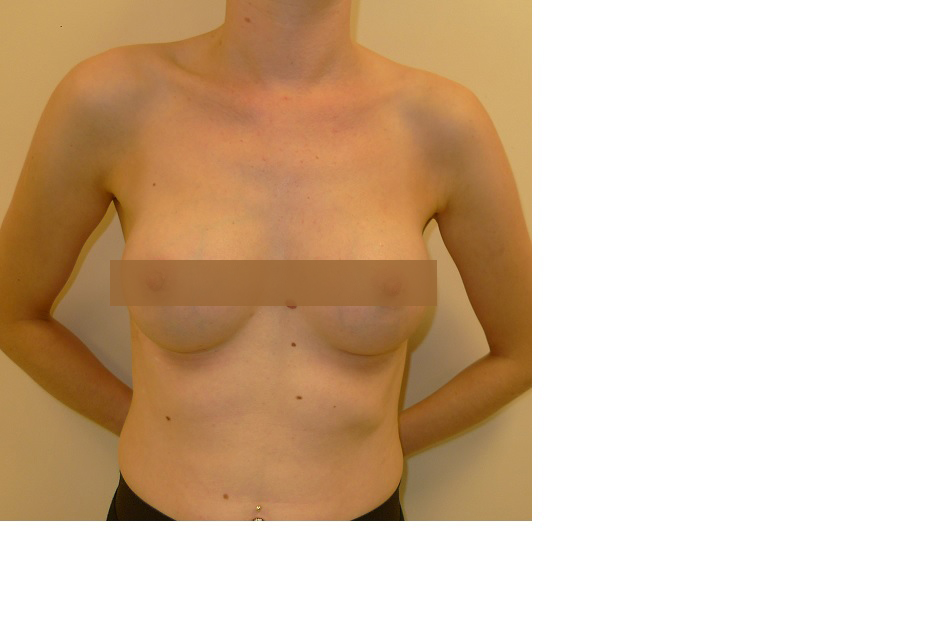 Crisalix 3D simulation- The Best Implants for Your Breast Enlargement-cosmetic-breast